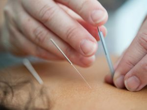Art Of Healing - Acupuncture